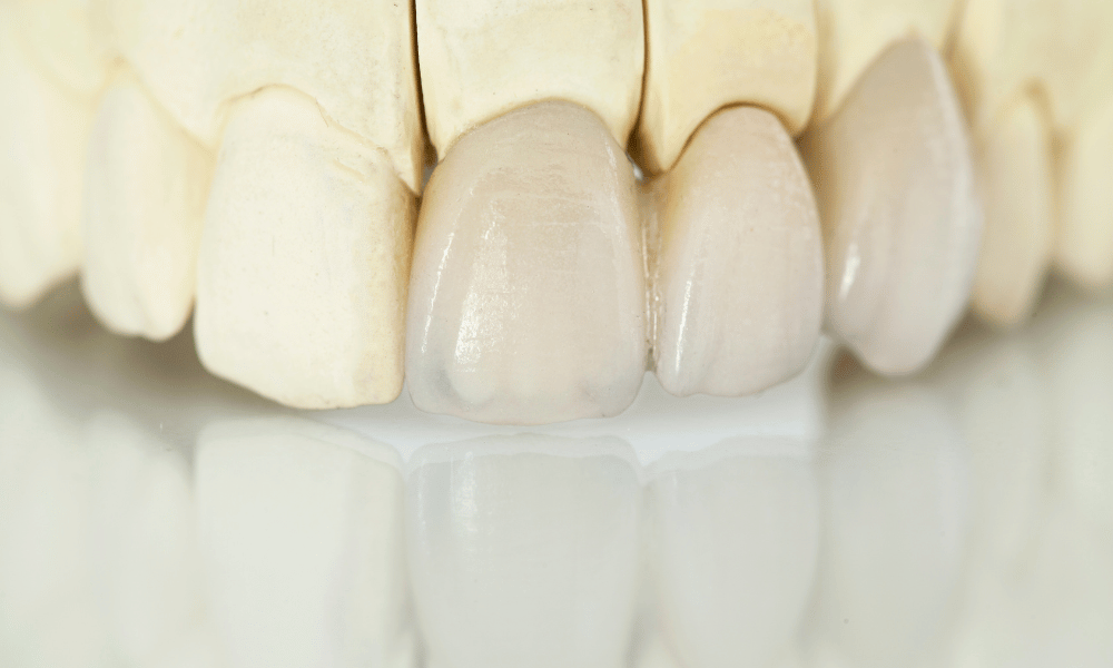 Guide to Zirconia Crown Preparation